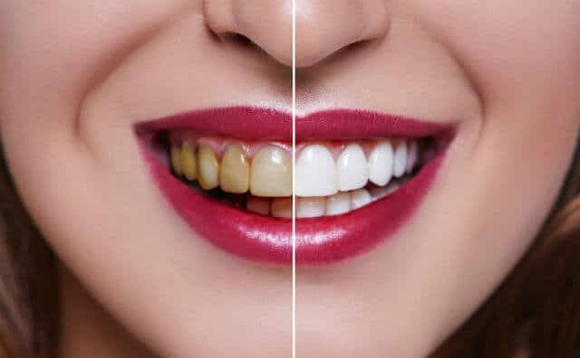 تنظيف و تبيض الأسنان